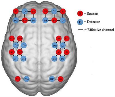 Cortical activity associated with focal muscle vibration applied directly to the affected forearm flexor muscle in post-stroke patients: an fNIRS study